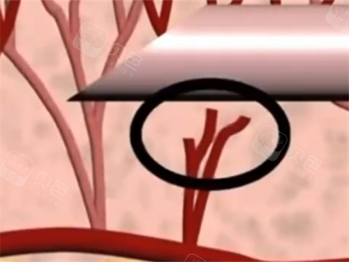 玻尿酸注射内部血管细节展示