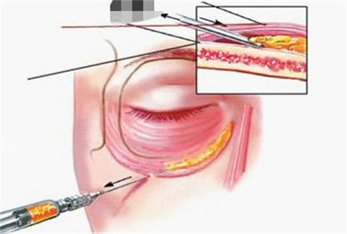 胶原蛋白注射眼部示意图