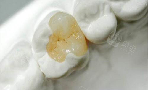 补牙后避免吃哪些食物？远离过冷过热辛辣刺激，防止刺激牙髓引发酸痛