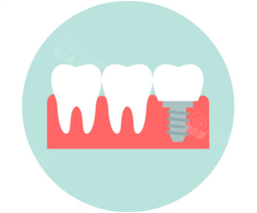 种植牙模拟卡通图