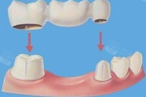 广州镶牙性价比之王？爱齿尔/爱顿/奥洋深度解析