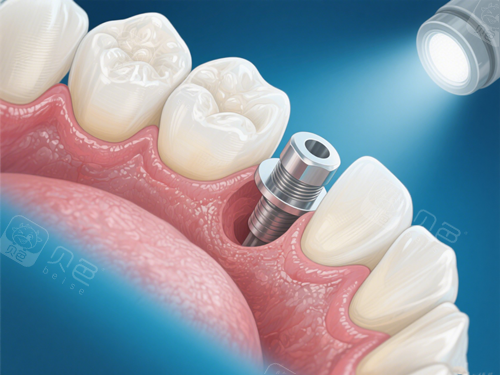 家人们谁懂啊！海口鼎点口腔种植牙体验超棒，让我告别缺牙烦恼！