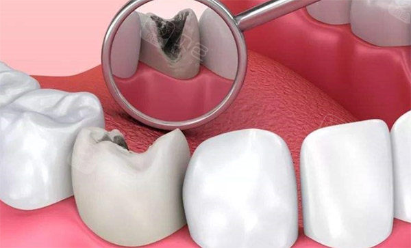 天呐！我在海口植之道口腔补牙的经历太绝了，结果好到爆，不看亏大啦！