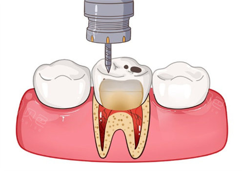 天呐！我在海口植之道口腔补牙的经历太绝了，结果好到爆，不看亏大啦！