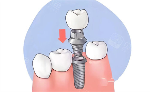 瑞典诺贝尔型号选错毁一生！Active与PCC怎么选？一篇文章看懂！