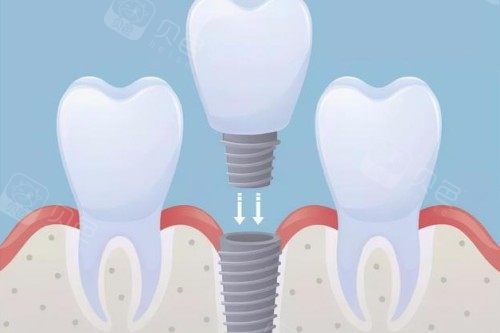 士卓曼和诺贝尔对决：谁才是种植界的“爱马仕”？深度测评告诉你！