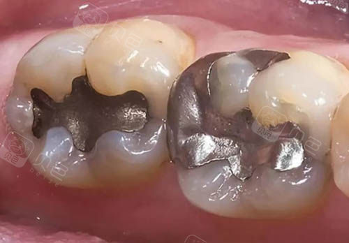 金属材料补牙细节图