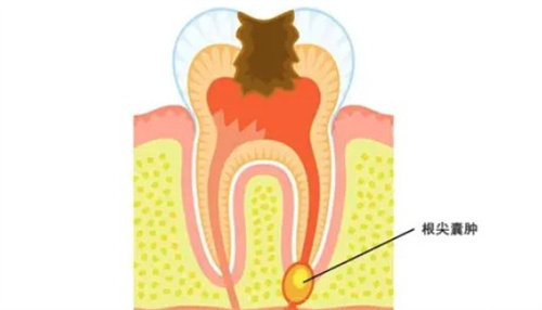 开髓了一周内去做根管治疗可以吗？可以！具体看牙齿情况！
