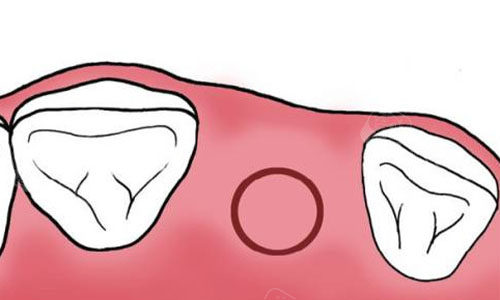 牙髓炎不想做根管治疗了怎么办？还有别的方法吗？