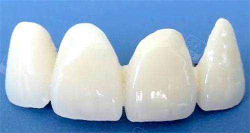 800元一颗的全瓷牙能用吗？拆解材料成本/工艺猫腻/隐形收费，甄别套路