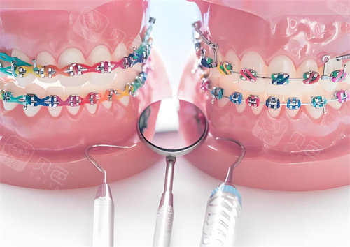 牙齿矫正模型图片