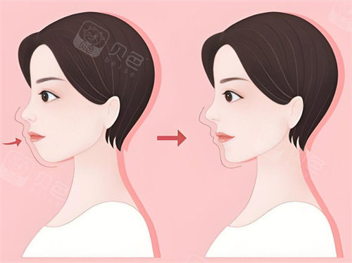 牙齿矫正前后对比