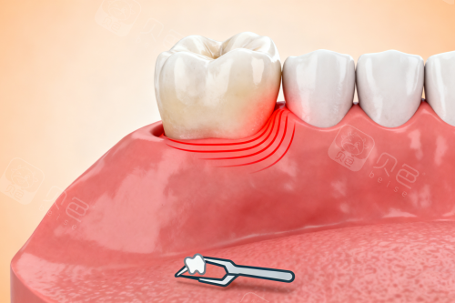 牙龈发炎变红卡通图