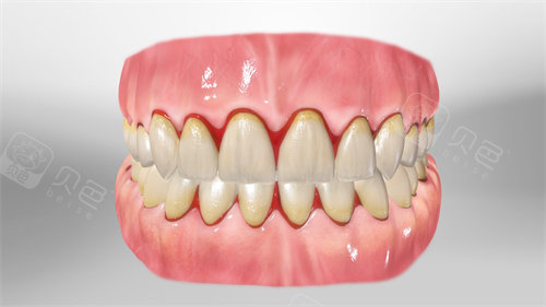 牙齿根部牙龈出血