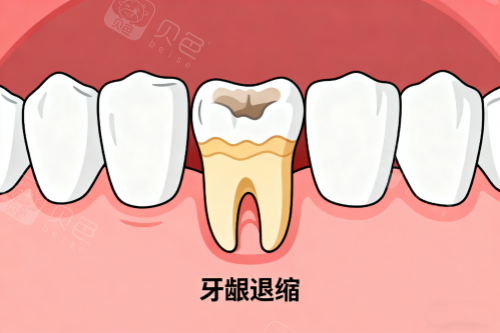 牙龈萎缩展示图