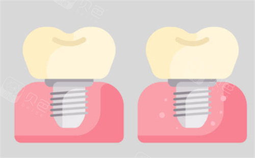 种植牙对比图