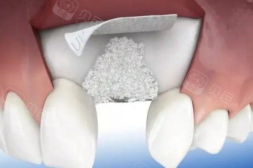 种植牙植骨卡通展示图