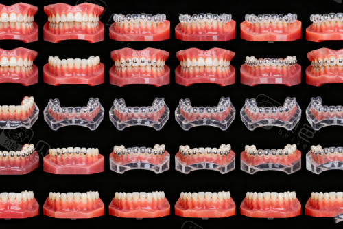 牙齿矫正步骤图展示