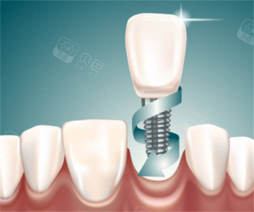 种植牙在口腔图