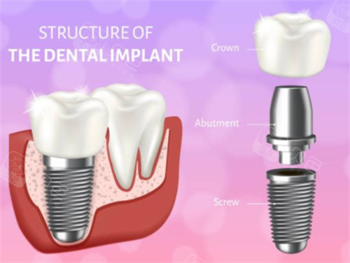 种植牙模拟示意图
