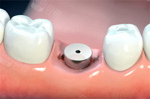 单颗种植牙愈合基台卡通图