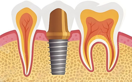 种植牙在线询问:24小时人工牙科问询|各地正规种牙医院免费挂号
