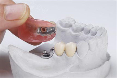 无挂钩假牙图