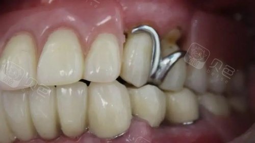 无挂钩假牙展示示意图