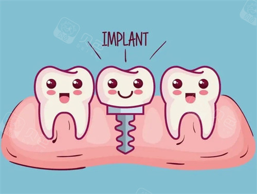 种植牙漫画示意图