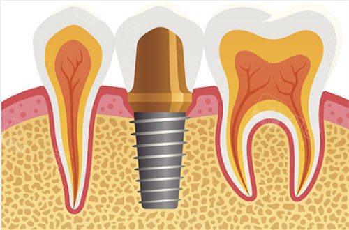种植牙和临牙图片