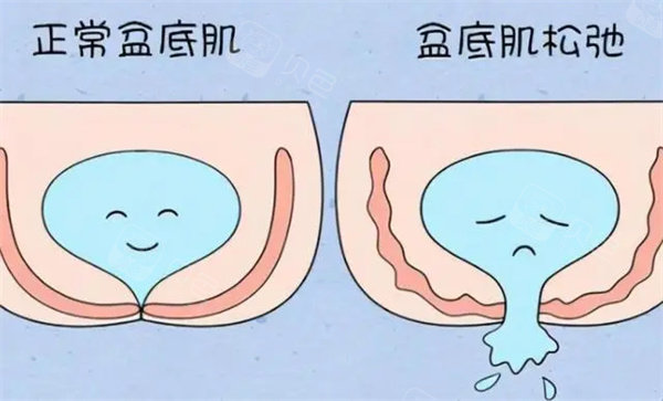 盆底肌修复图片