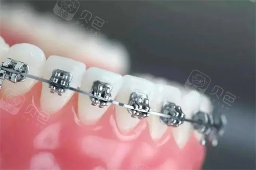 金属自锁托槽矫正