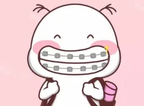 金属自锁牙套示意图