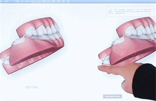 隐形牙齿矫正3D模型展示