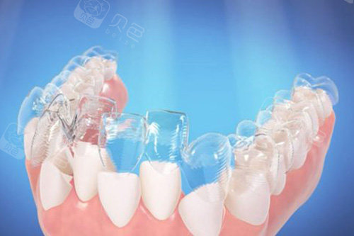 隐形牙套矫正牙齿示意图