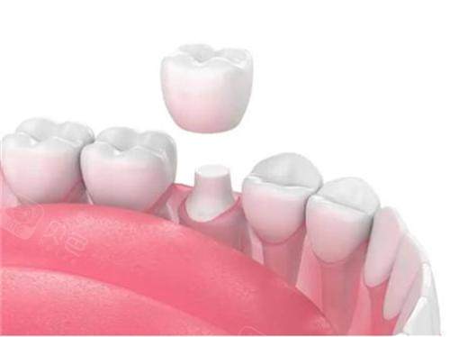 格莱美全瓷牙冠质量怎么样？2026耐磨性、生物相容性及价格大拆解