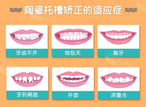 陶瓷半隐形矫正适应症