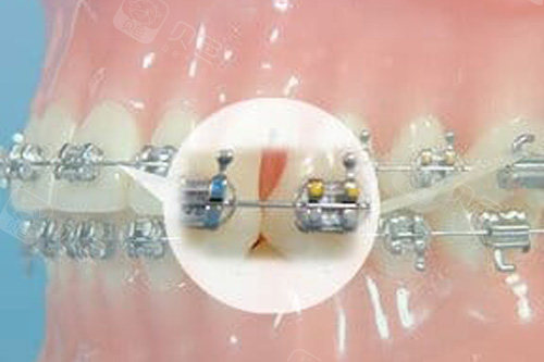 牙齿矫正细节图