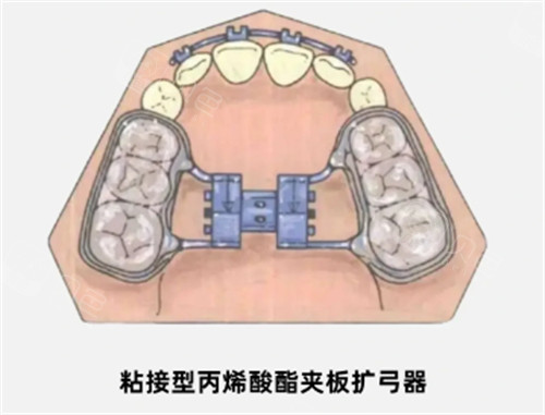 基托式螺旋扩弓器多少钱
