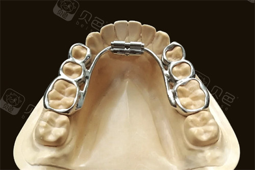 扩弓器固定款VS活动款PK！清洁难易/发音影响/结果差异全测评！