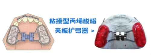 粘接式扩弓器实拍