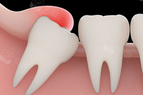 智齿肿胀示意图