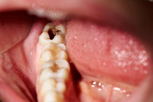 智齿蛀牙已经烂空示意图