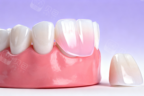 牙贴面卡通展示图