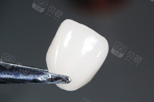 牙贴面材料展示图