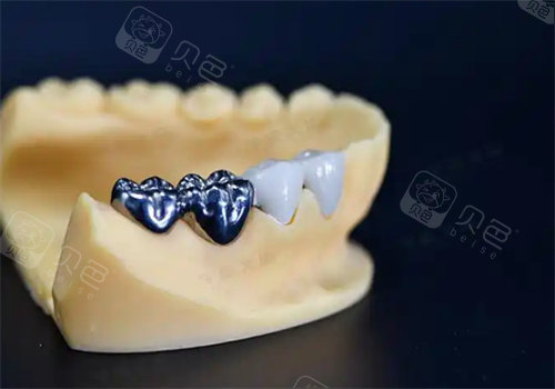 纯钛一体冠牙齿