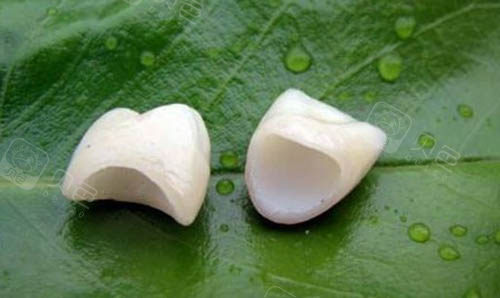 全瓷牙冠照片实物图