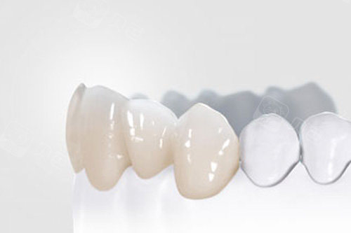 全瓷牙冠模型图