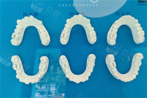 北京美笑口腔牙齿矫正成效对比图