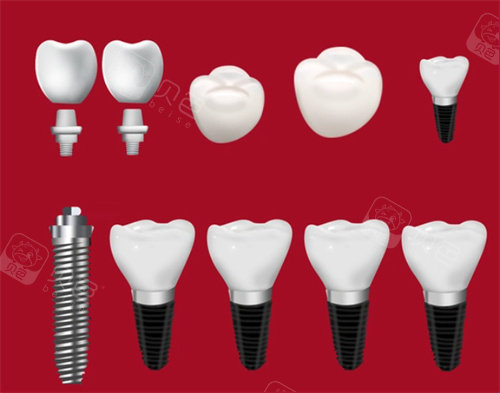 种植牙种植体牙冠
